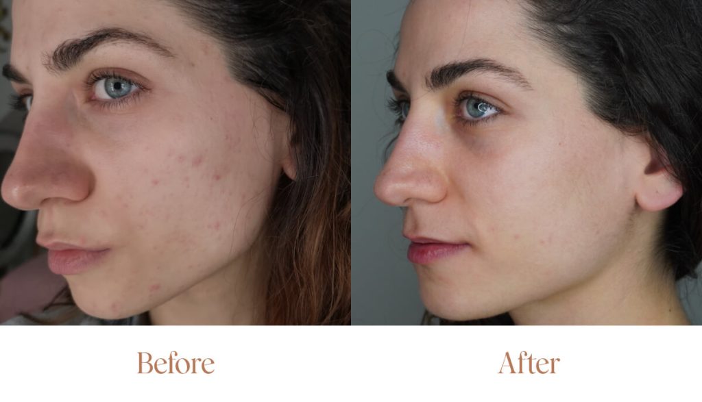 come curare l'acne